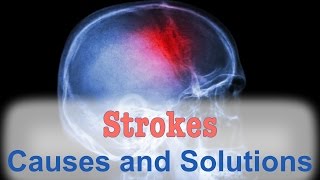 The Natural Solution for Strokes