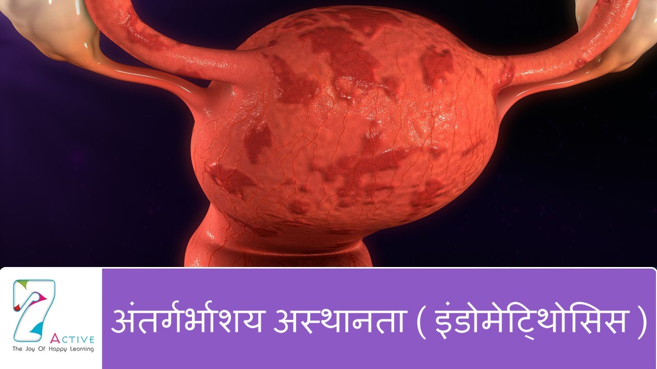 Watch video अंतर्गर्भाशय अस्थानता ( इंडोमेटि्थोसिस ) | Endometriosis | Hindi Now अंतर्गर्भाशय अस्थानता ( इंडोमेटि्थोसिस ) | Endometriosis | Hindi