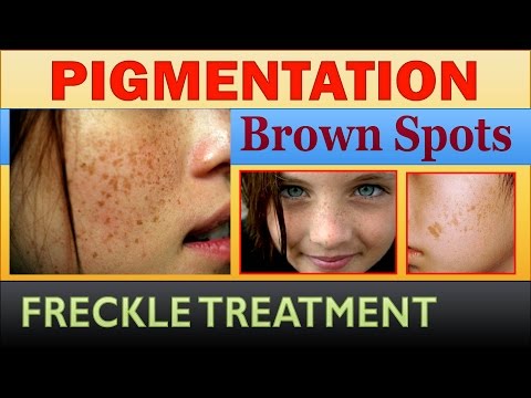 Pigmentation, Freckle, Brown Moles and Spots Complete Treatment with Home Remedies