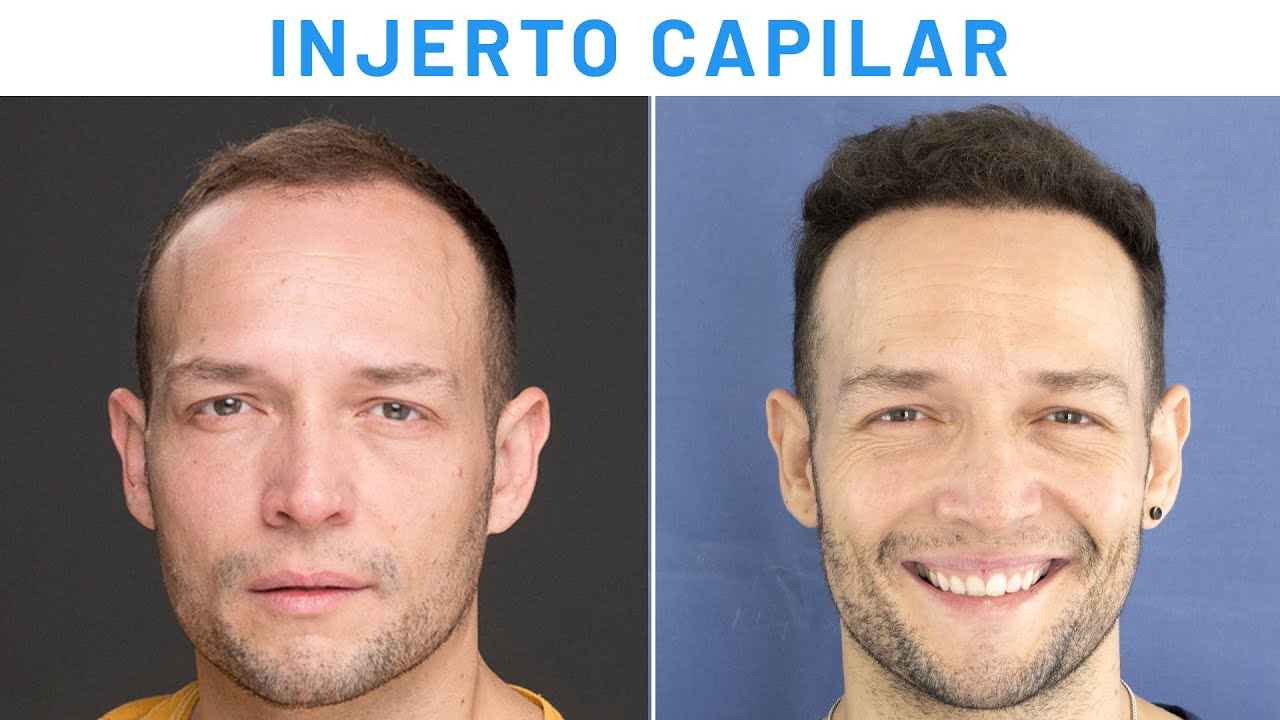 Resultados de IMPLANTE CAPILAR | 🦲 Antes y Después 🧔🏽 Clínicas Diego de León