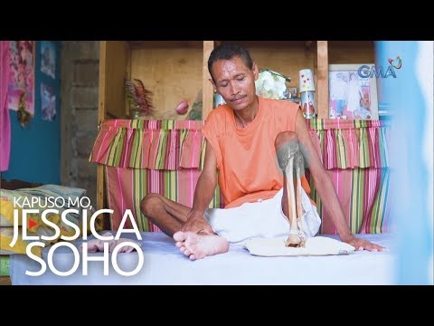 , title : 'Kapuso Mo, Jessica Soho: Ano ang nangyari sa kaliwang binti ni Mang Singlito?'