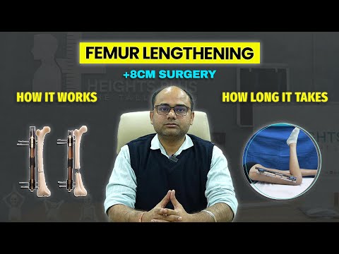 Doctor Explains Femur Lengthening (+8 CM) | How Height Increase Surgery Works | Heights Plus