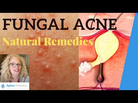 FUNGAL ACNE | MALASSEZIA FOLLICULITIS | NATURAL REMEDIES
