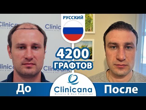 Пересадка волос Турции | Наш пациент из России делится своим результатом