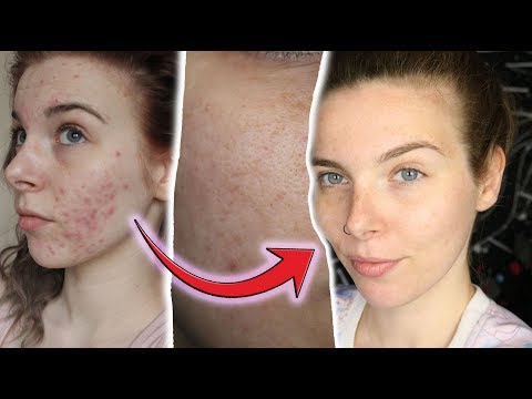 MICRONEEDLING DERMAROLLER gegen AKNENARBEN für zu Hause - Was bringt es wirklich?