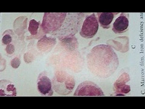 Haemolytic Disease Of New Born