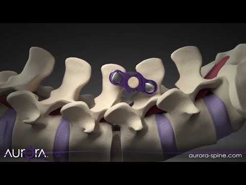 Posterior Interbody Surgical Technique Guide