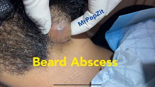 Beard Abscess. Pus filled pocket popped and drained. Ingrown hairs. I +D with packing. MrPopZit
