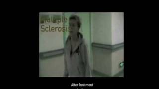 Stem Cells - Multiple Sclerosis - Arabic