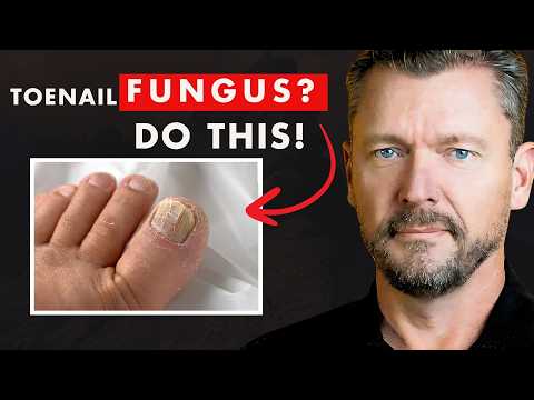 CURE Toenail Fungus (And keep it Gone FOREVER)