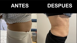 Cirugía Laparoscópica para Diástasis de Rectos y Hernia en Guadalajara, Dr Hector Valenzuela