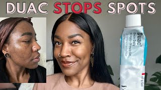DUAC Gel For Acne | Benzoyl Peroxide & Clindamycin | My Experience - DOES DUAC WORK