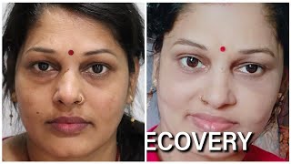 Get rid of Puffy Eyes forever in just 45 mins | Eye Bags Removal Surgery | Lower Lid Blepharoplasty