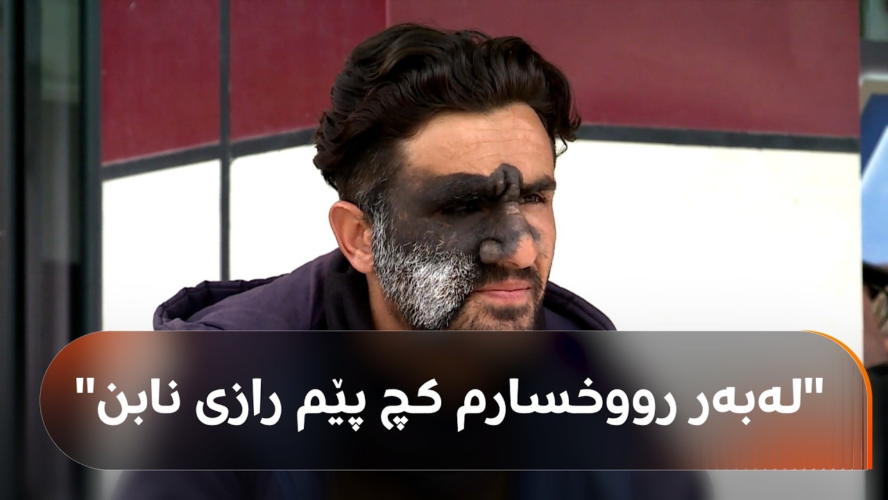 ڤیدیۆ | ئەم گەنجە لەو رۆژەوەی لەدایک بووە لایەکی رووخساری رەشی موودارە و پارەی نییە بۆ چارەسەر