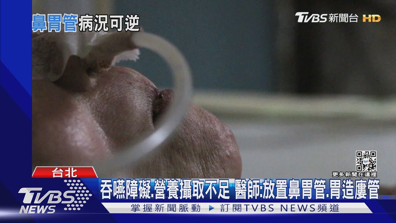 出現「這症狀」必須插鼻胃管或胃造廔...醫師：關鍵因素..是這件事！