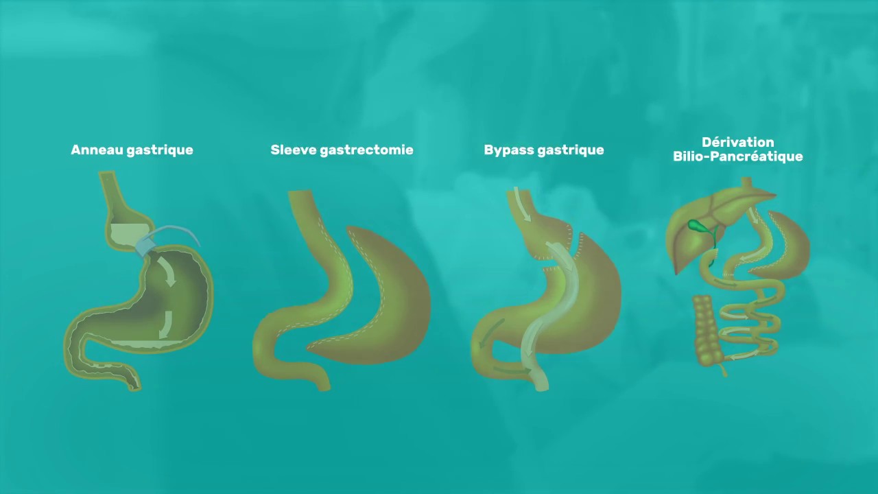 Quelles sont les différentes techniques chirurgicales ?