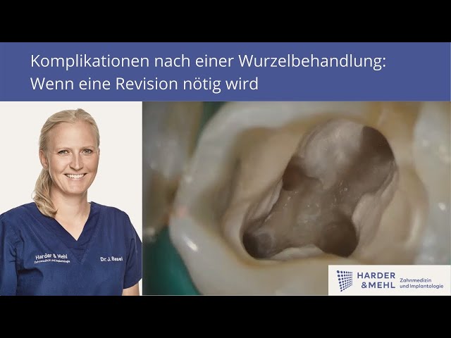 Entzundung Nach Einer Wurzelbehandlung Revision