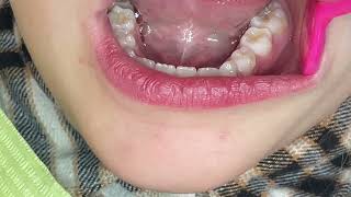 How do I instrument a deciduous tooth?