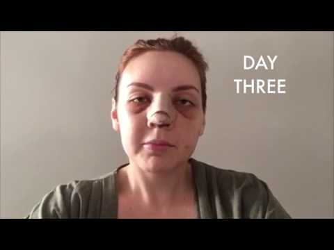 Rhinoplasty Surgical Journey, Part 2