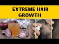 I Tried Onion Juice For Hair Growth And Here S What Happened