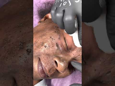 The Extractions