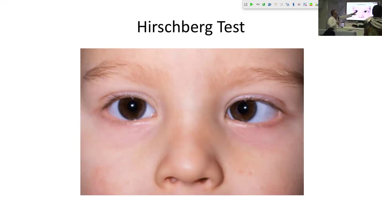 Lecture: Esotropia-Exotropia: Dr. Carlos Solarte - YouTube