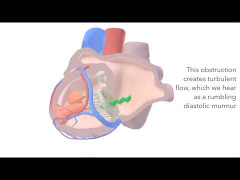 Mitral Stenosis - sound & animation