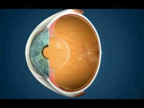 What is myopia?