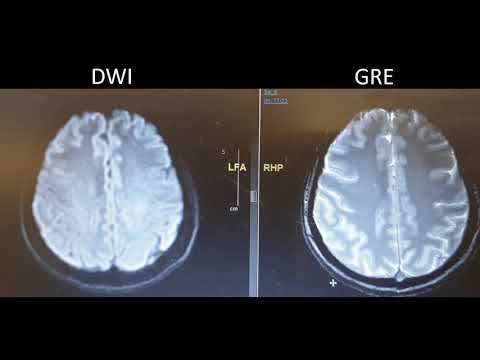 SYNAPSE 101 How to read a MR Stroke protocol
