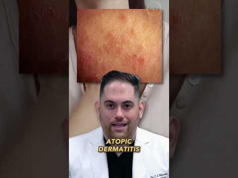 Can you tell if it's eczema or psoriasis?