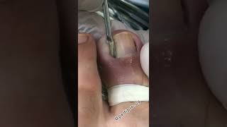 Unha Mega Encravada 😍