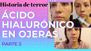 🚨Cómo solucionar ácido hialurónico 😞💉 mal aplicado #ácidohialurónico #ojeras #rellenosfaciales