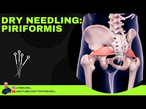 乾針療法：梨狀肌 (Dry Needling: Piriformis)