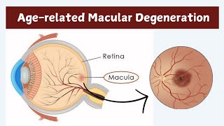 What is Age-related macular Degeneration AMD ?