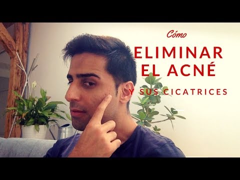 Como Curar el Acne Para Siempre – Como Borrar y Eliminar las Cicatrices Del Acné.