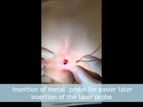 Entzündung des Gelenks auf der großen Zehe Foto Behandlung Kyphose Halswirbelsäule Massage Video