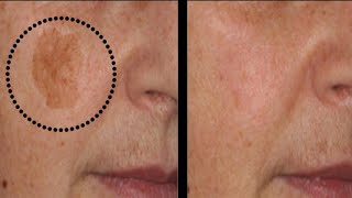 Remove Dark Spots, Brown Spots and get Crystal clear skin | Dr. Vivek Joshi