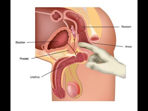 Moderate Prostatahyperplasie mit chronischer Prostatitis BPH-Screening