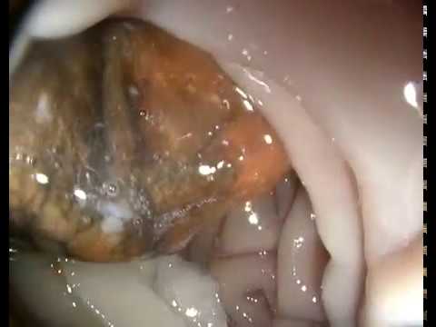 Foreign body removal by endoscopy in a dog