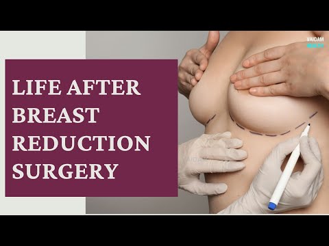 Life After Breast Reduction