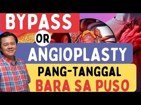 Bypass Or Angioplasty: Pang-tanggal ng Bara sa Puso. -By Doc Willie Ong (Internist and Cardiologist)