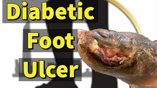 Diabetic Foot Ulcer: Removing the Dead Tissue with Sharp Debridement
