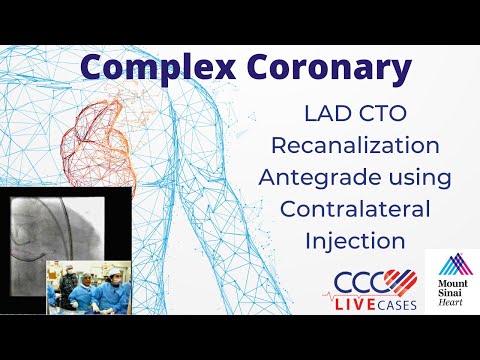 LAD CTO Recanalization Antegrade using Contralateral Injection - February 16, 2010 Webcast Video