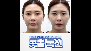 입술, 팔자, 눈밑 필러시술영상 비엘에스의원 본점