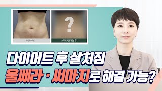 슈링크 오리지널 버전. 바디 울쎄라 리프팅 효과는?