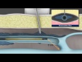 ClosureFast Procedure AnimationWMV File 2