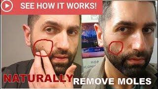 How To NATURALLY Remove Moles (This Works!)