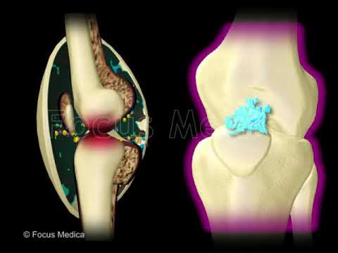 Ízületi osteodystrophia kezelés