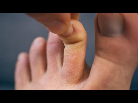 Goodbye hammer toes and claw toes 👋