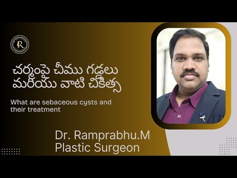 Sebaceous cyst treatment video thumbnail by Dr. Ram Prabhu.